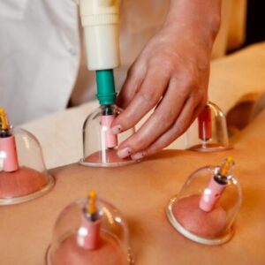 Cupping Therapy