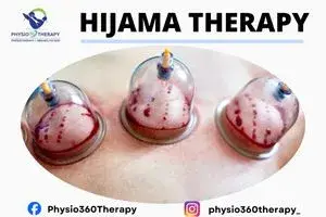 Hijama Therapy (1)